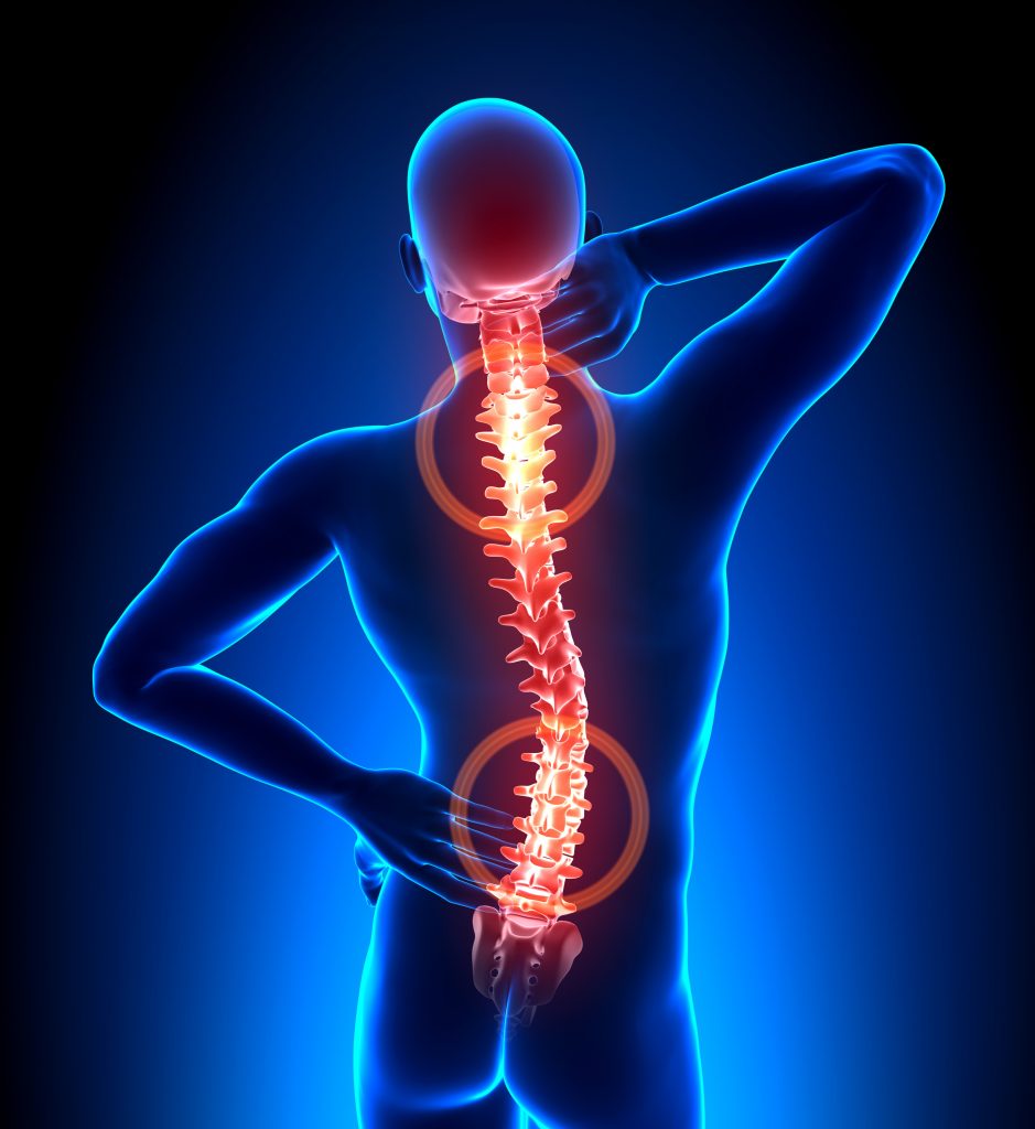 Important Information Over Spinal Stenosis Leadership And Motivation